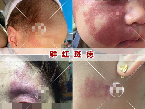鲜红斑痣,贵阳脉通血管医院
